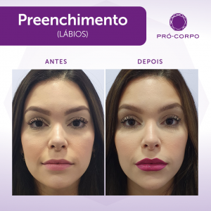 Preenchimento Fotos Antes e Depois